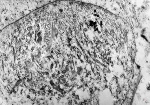 F,49y. | rhabdomyosarcoma - pankreas